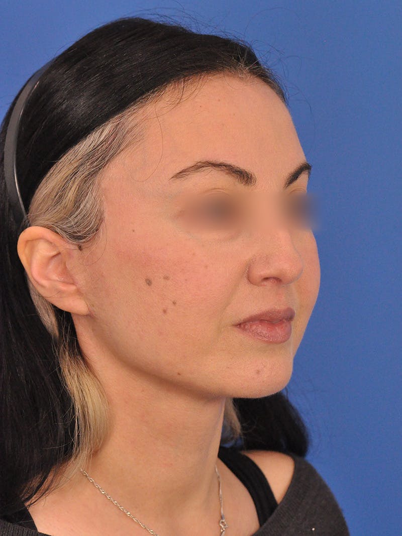 Facelift Before & After Gallery - Patient 215528 - Image 4