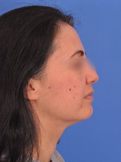 Neck Lift Before & After Gallery - Patient 170304 - Image 1