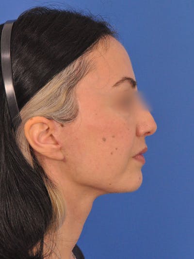 Neck Lift Before & After Gallery - Patient 170304 - Image 2