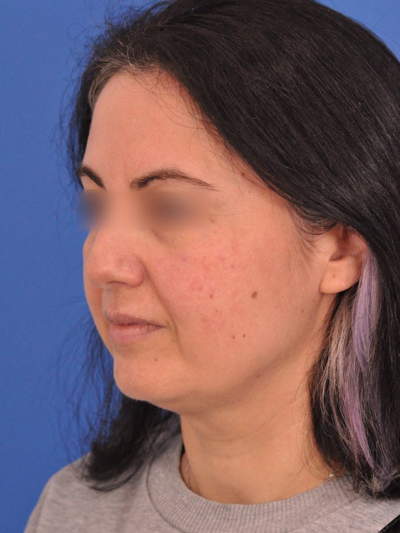Facelift Before & After Gallery - Patient 215528 - Image 7