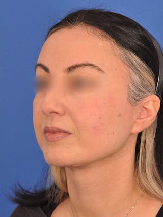 Facelift Before & After Gallery - Patient 215528 - Image 8