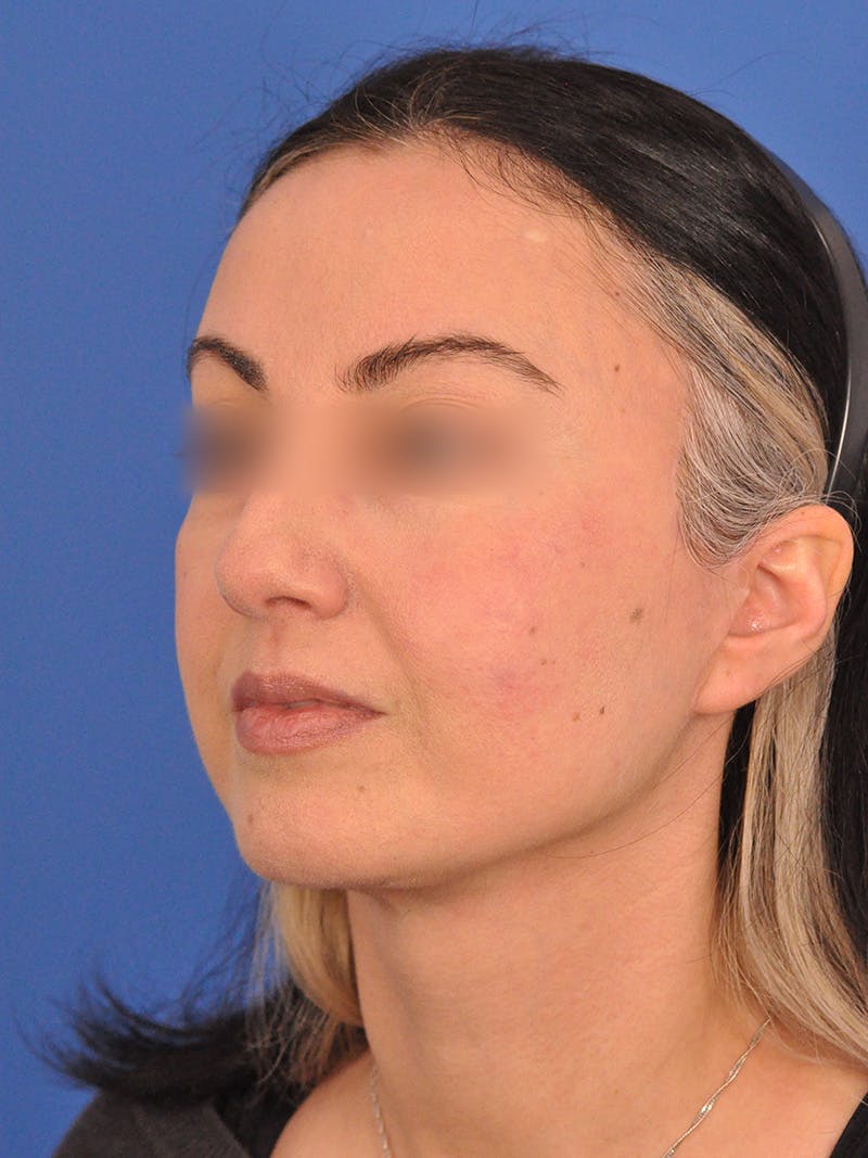 Facelift Before & After Gallery - Patient 215528 - Image 8