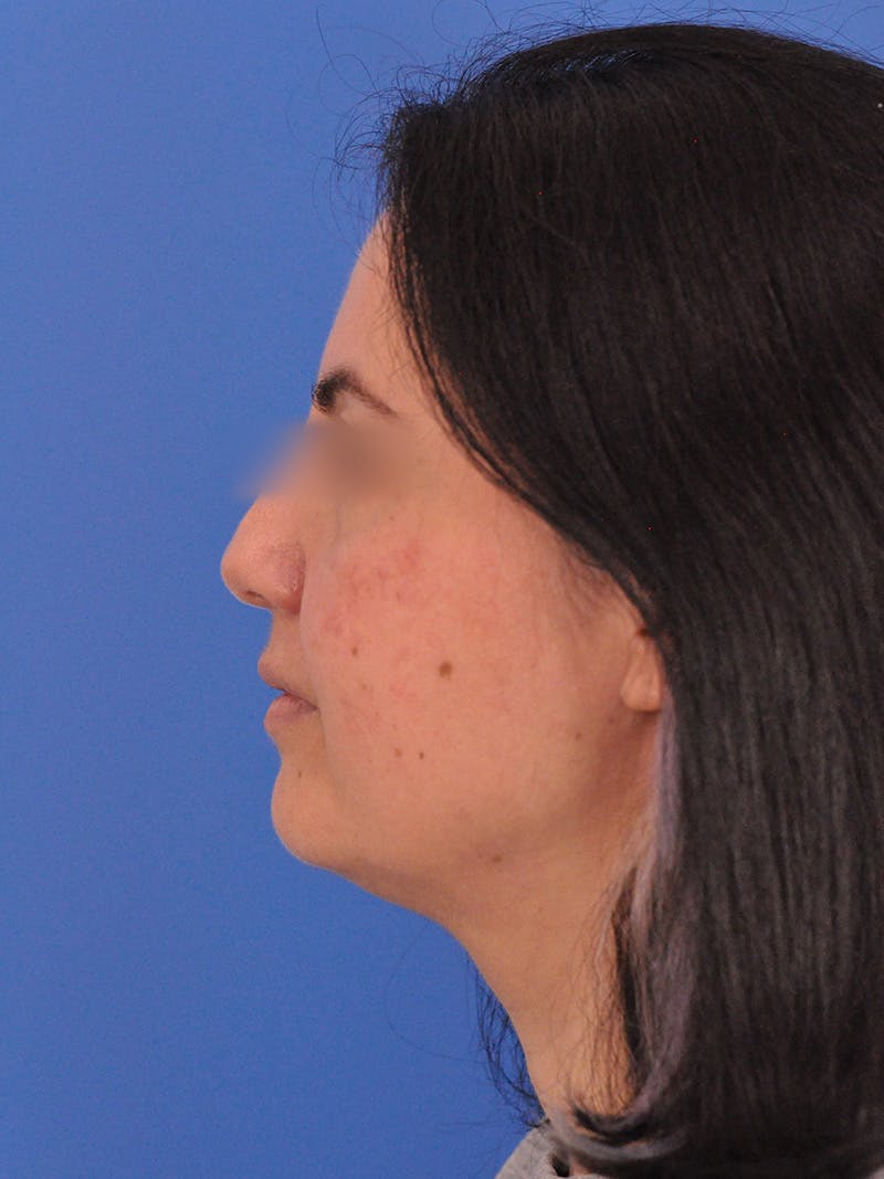 Facelift Before & After Gallery - Patient 215528 - Image 9