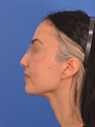 Facelift Before & After Gallery - Patient 215528 - Image 10