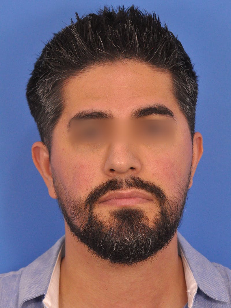 Rhinoplasty Before & After Gallery - Patient 281906 - Image 5