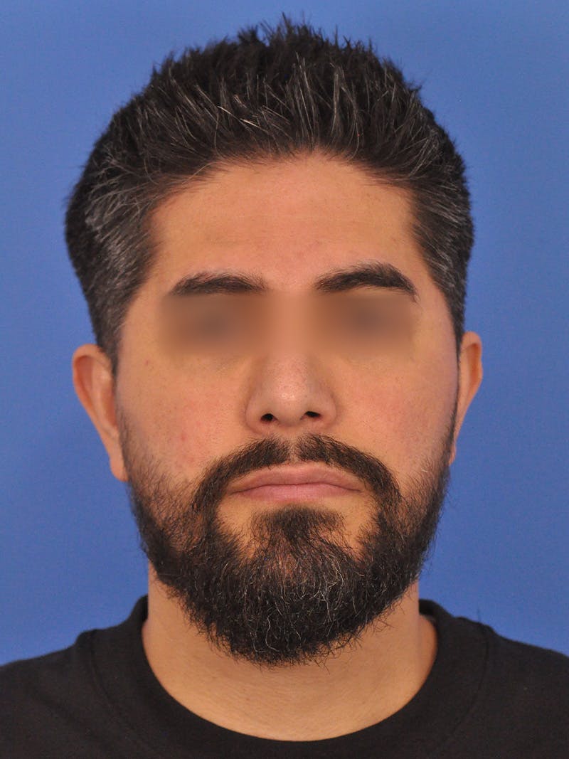 Rhinoplasty Before & After Gallery - Patient 281906 - Image 6