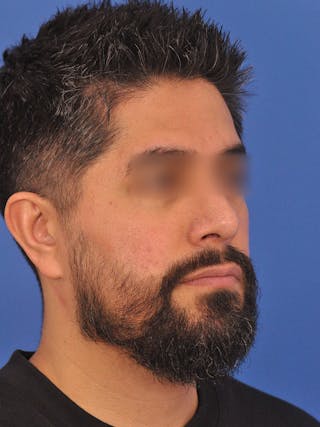 Rhinoplasty Before & After Gallery - Patient 281906 - Image 4
