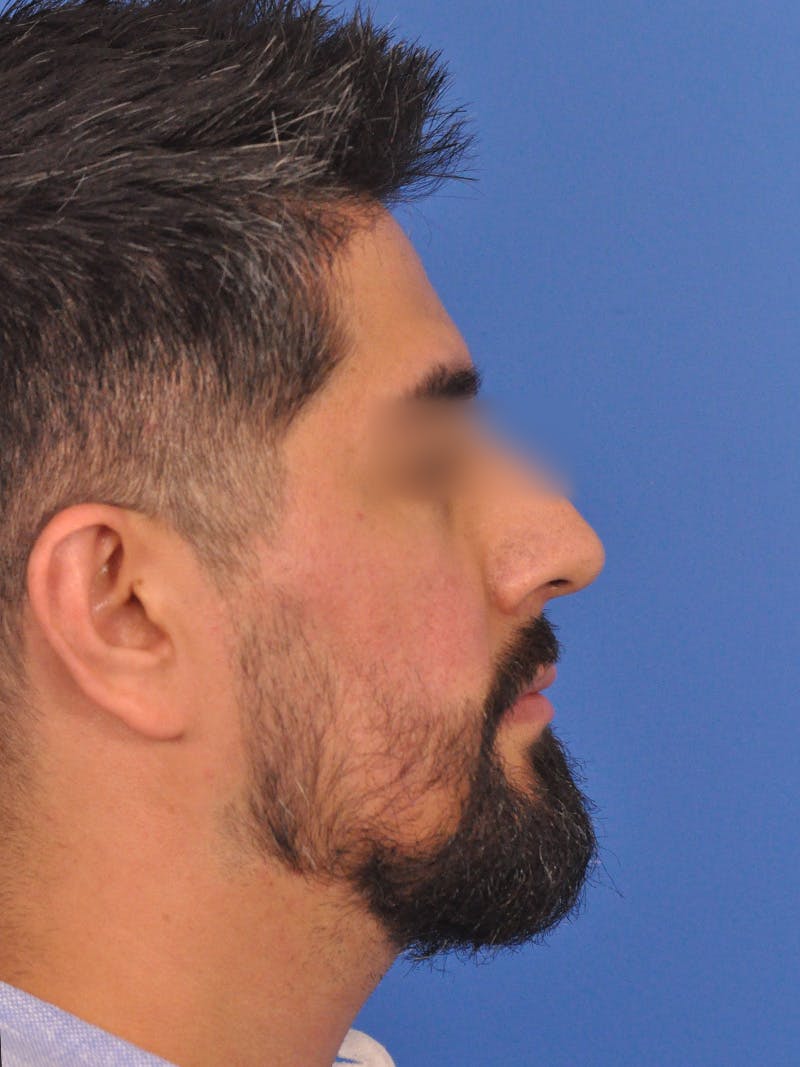 Rhinoplasty Before & After Gallery - Patient 281906 - Image 1