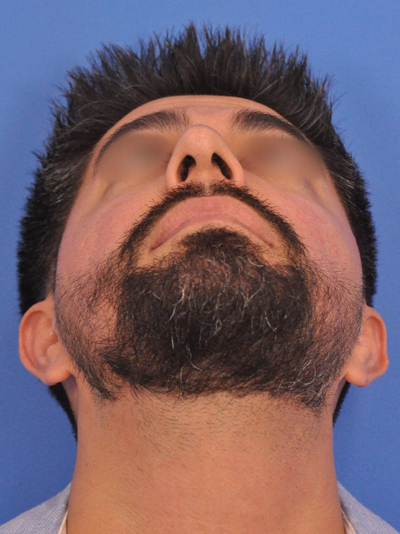 Rhinoplasty Before & After Gallery - Patient 281906 - Image 7