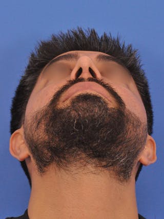 Rhinoplasty Before & After Gallery - Patient 281906 - Image 8