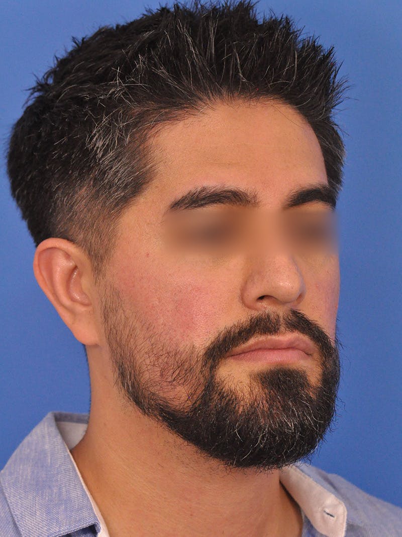 Rhinoplasty Before & After Gallery - Patient 281906 - Image 3