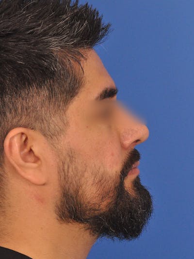 Rhinoplasty Before & After Gallery - Patient 281906 - Image 2