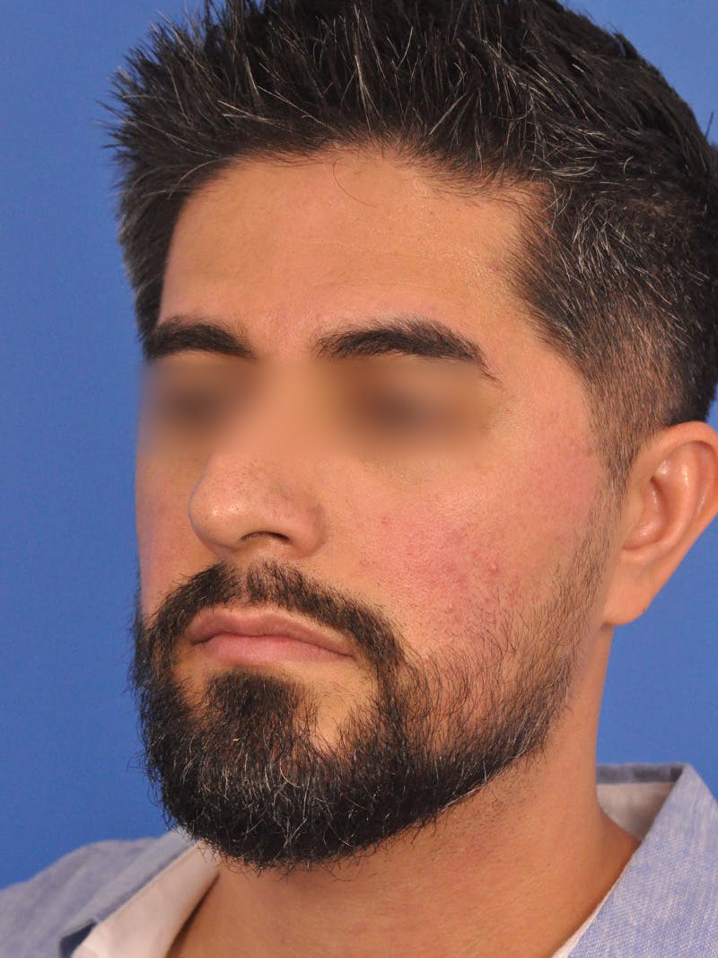 Rhinoplasty Before & After Gallery - Patient 281906 - Image 9