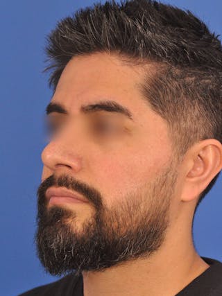 Rhinoplasty Before & After Gallery - Patient 281906 - Image 10