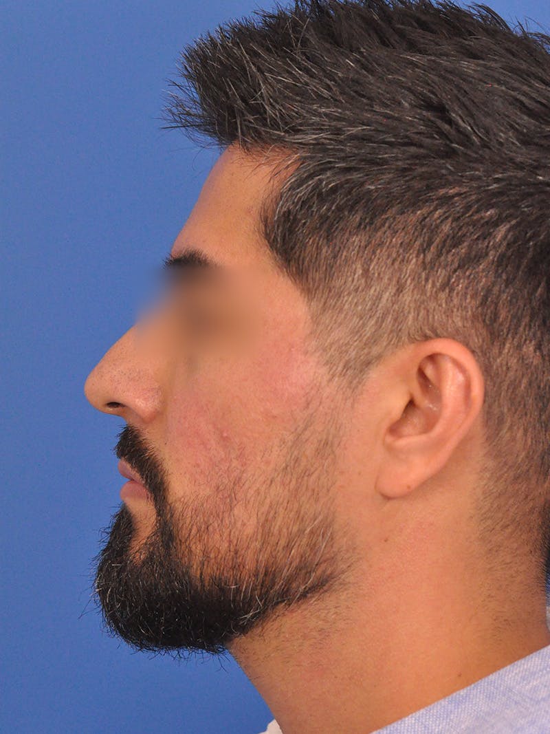 Rhinoplasty Before & After Gallery - Patient 281906 - Image 11