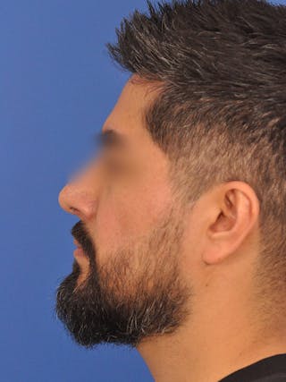 Rhinoplasty Before & After Gallery - Patient 281906 - Image 12