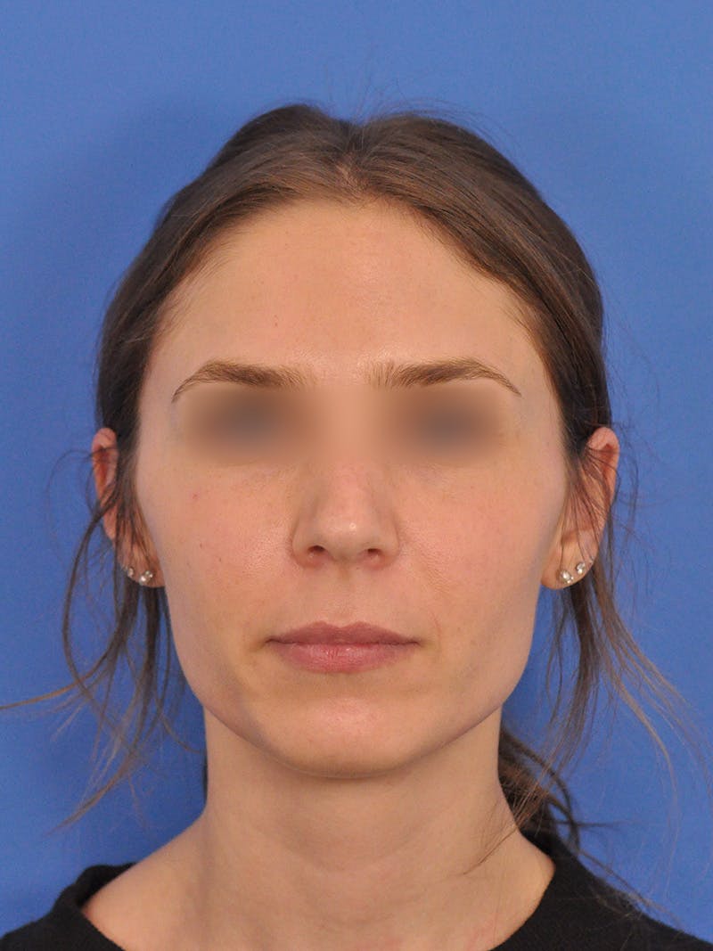Rhinoplasty Before & After Gallery - Patient 390692 - Image 5