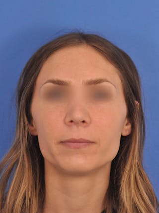 Rhinoplasty Before & After Gallery - Patient 390692 - Image 6