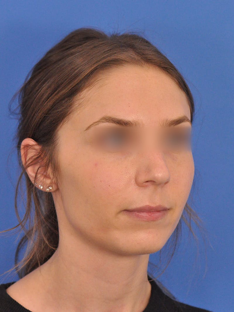 Rhinoplasty Before & After Gallery - Patient 390692 - Image 3