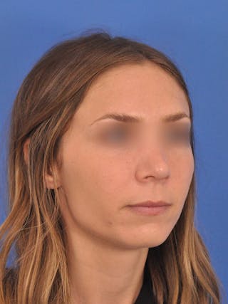 Rhinoplasty Before & After Gallery - Patient 390692 - Image 4
