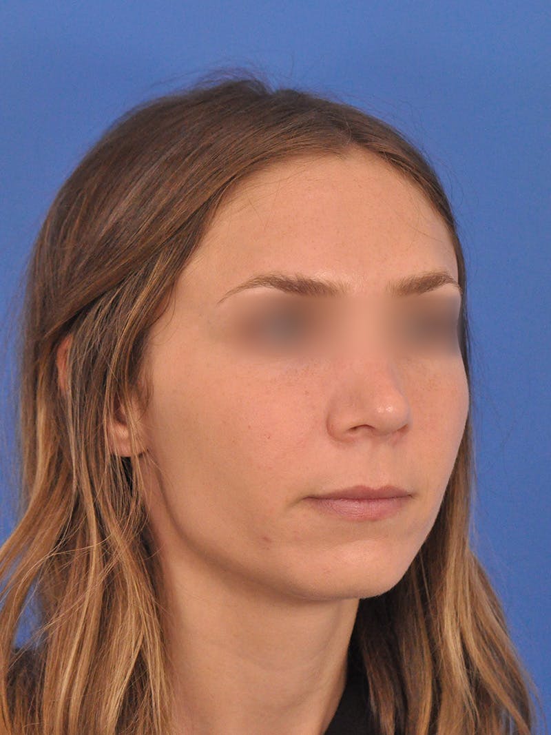 Rhinoplasty Before & After Gallery - Patient 390692 - Image 4