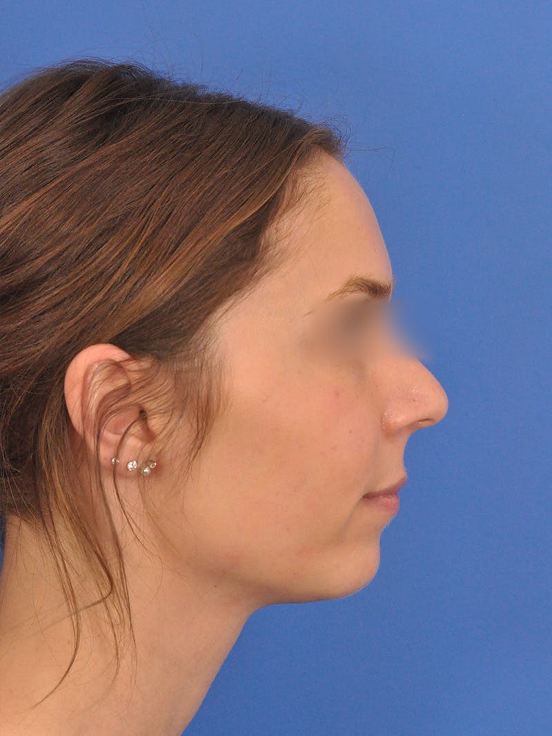 Rhinoplasty Before & After Gallery - Patient 390692 - Image 1