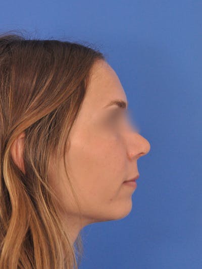 Rhinoplasty Before & After Gallery - Patient 390692 - Image 2