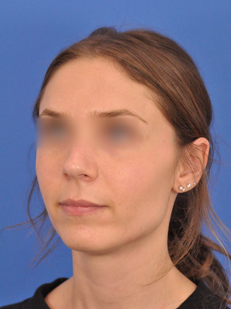 Rhinoplasty Before & After Gallery - Patient 390692 - Image 7