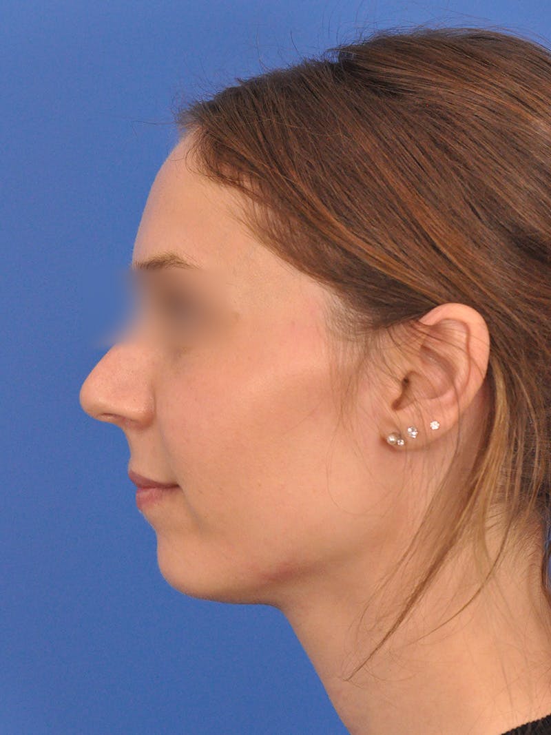 Rhinoplasty Before & After Gallery - Patient 390692 - Image 9
