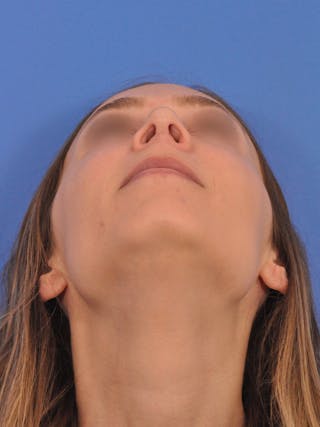Rhinoplasty Before & After Gallery - Patient 390692 - Image 12