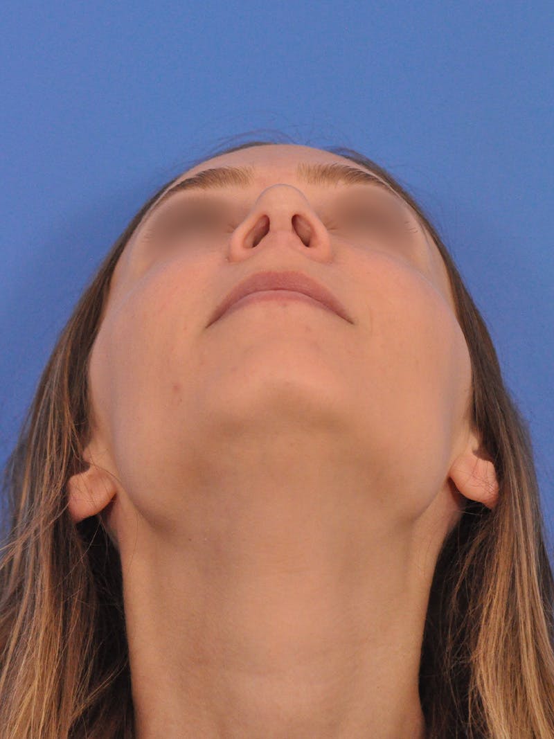 Rhinoplasty Before & After Gallery - Patient 390692 - Image 12
