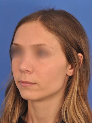 Rhinoplasty Before & After Gallery - Patient 390692 - Image 8