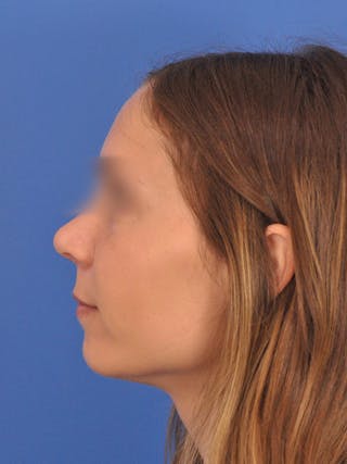 Rhinoplasty Before & After Gallery - Patient 390692 - Image 10