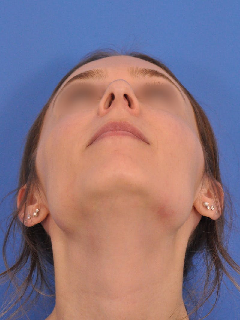 Rhinoplasty Before & After Gallery - Patient 390692 - Image 11