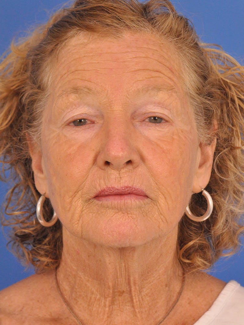 Brow Lift Before & After Gallery - Patient 393166 - Image 1