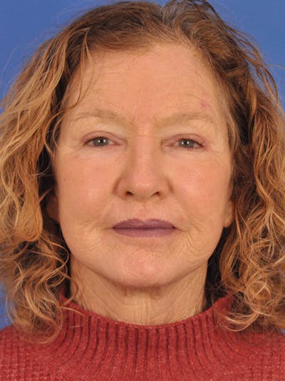 Brow Lift Before & After Gallery - Patient 393166 - Image 2