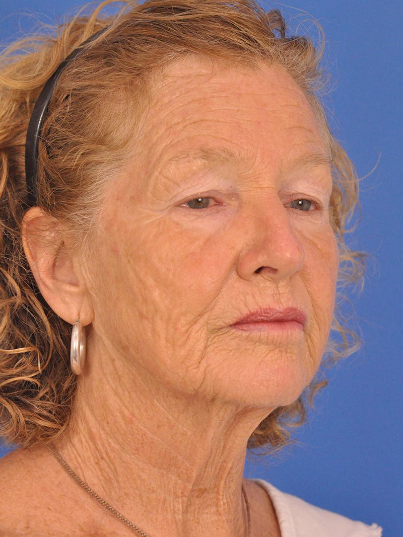 Brow Lift Before & After Gallery - Patient 393166 - Image 3