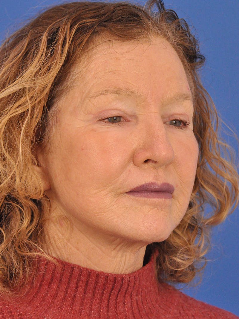 Brow Lift Before & After Gallery - Patient 393166 - Image 4
