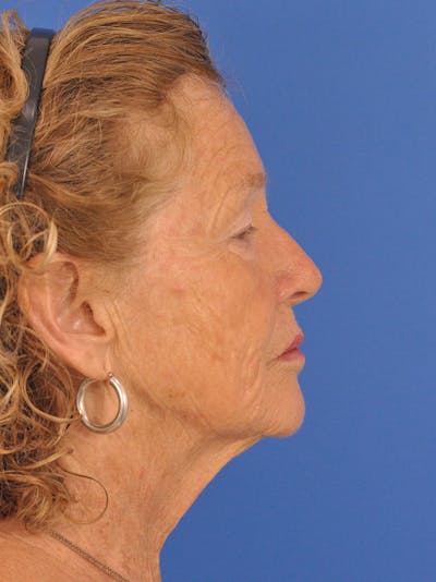 Neck Lift Before & After Gallery - Patient 741170 - Image 1