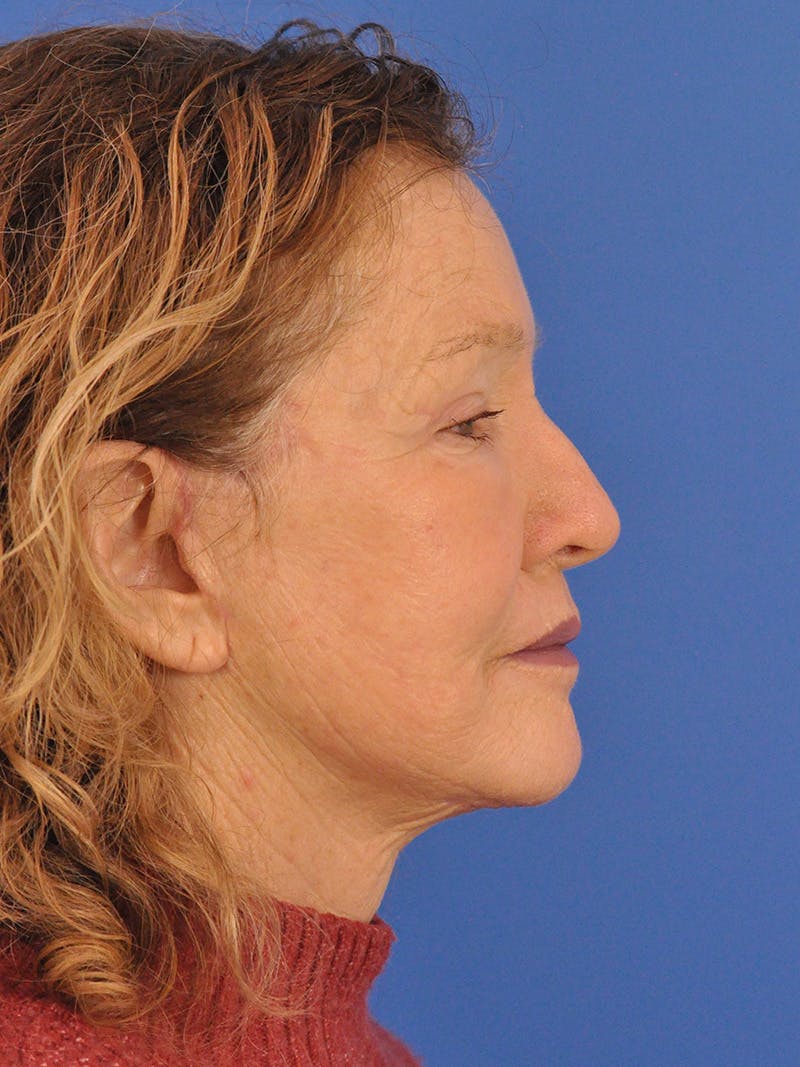 Brow Lift Before & After Gallery - Patient 393166 - Image 6