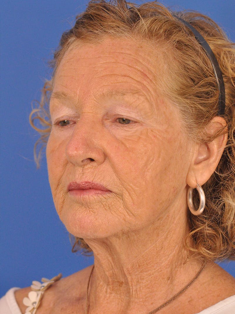 Brow Lift Before & After Gallery - Patient 393166 - Image 7
