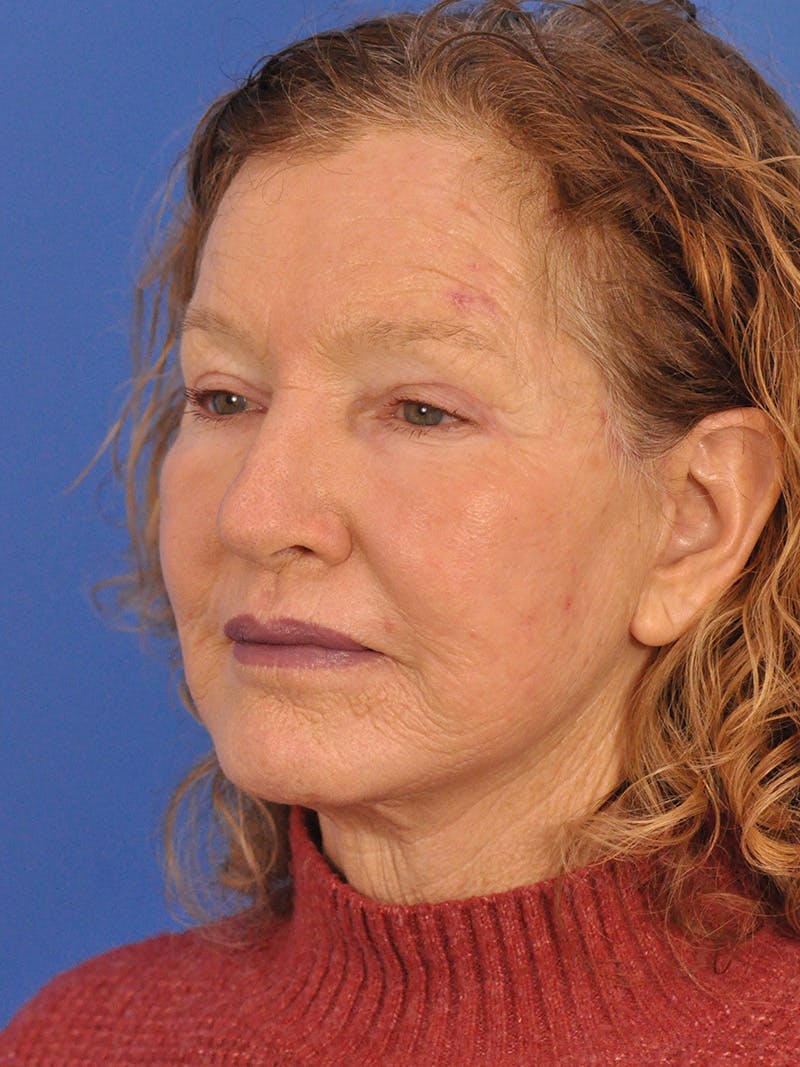 Brow Lift Before & After Gallery - Patient 393166 - Image 8