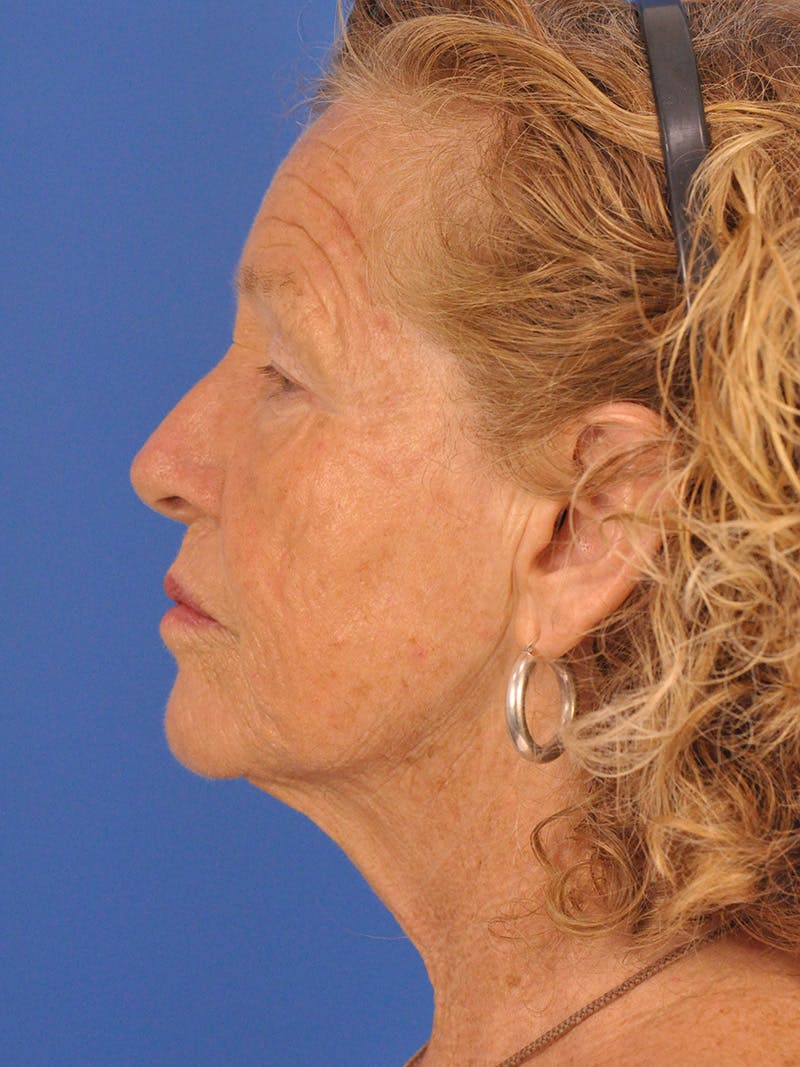 Brow Lift Before & After Gallery - Patient 393166 - Image 9