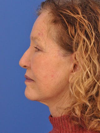 Brow Lift Before & After Gallery - Patient 393166 - Image 10