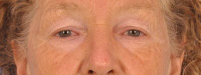 Blepharoplasty Before & After Gallery - Patient 100117 - Image 1