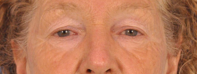 Blepharoplasty Before & After Gallery - Patient 100117 - Image 1