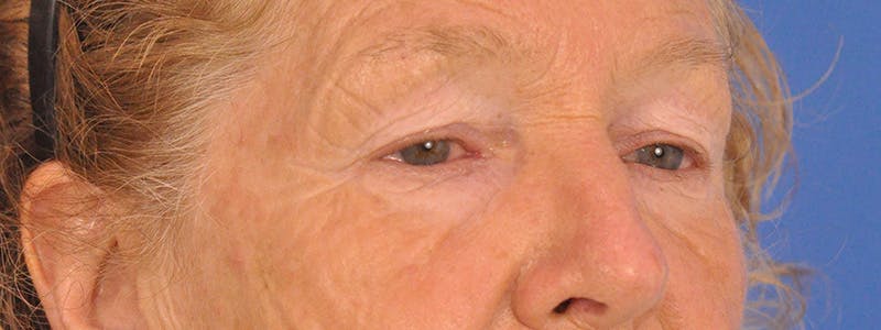 Blepharoplasty Before & After Gallery - Patient 100117 - Image 3