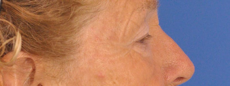 Blepharoplasty Before & After Gallery - Patient 100117 - Image 5
