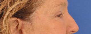 Blepharoplasty Before & After Gallery - Patient 100117 - Image 6