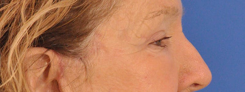 Blepharoplasty Before & After Gallery - Patient 100117 - Image 6